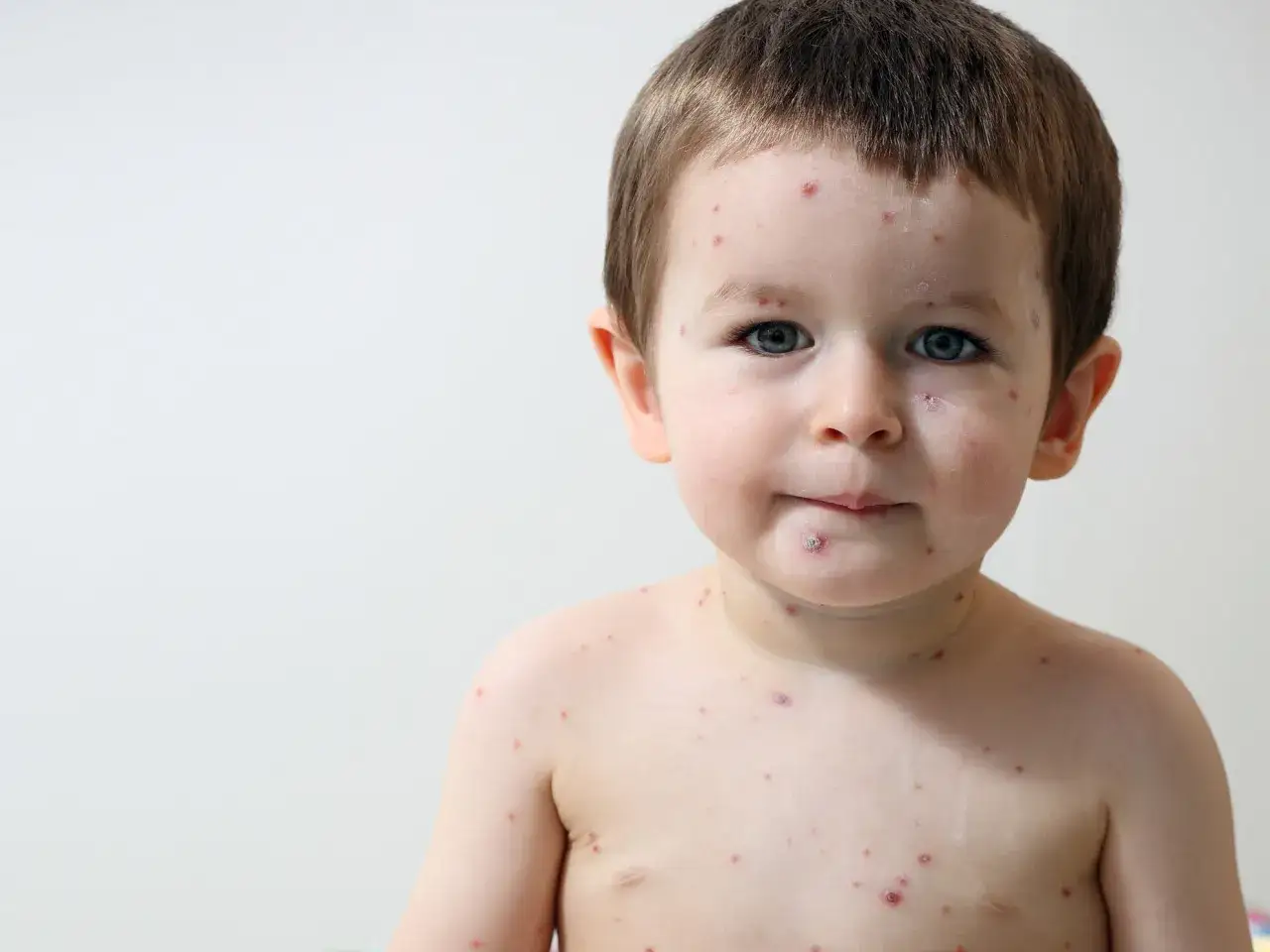 Bambino con macchie rosse sulla pelle, forse varicella. Le piccole eruzioni cutanee sono visibili sul viso, collo e petto.