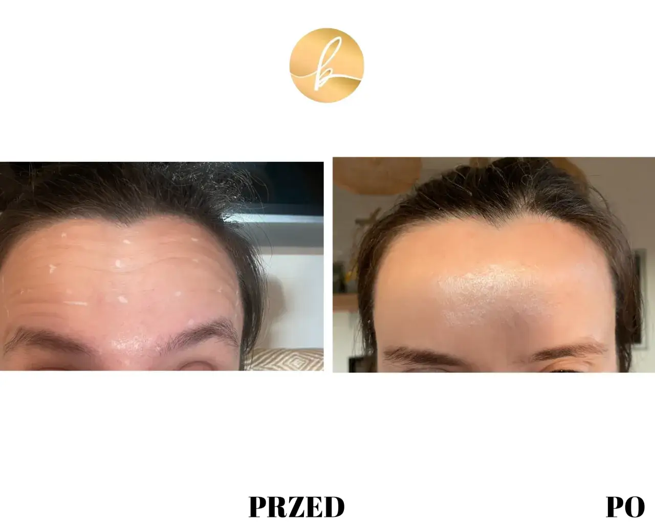 baby botox czoło