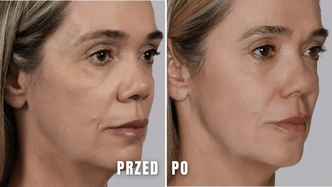 Przed i po chirurgicznym liftingu twarzy. Zmarszczki wygładzone, skóra napięta. Opinie potwierdzają efekt odmłodzenia.