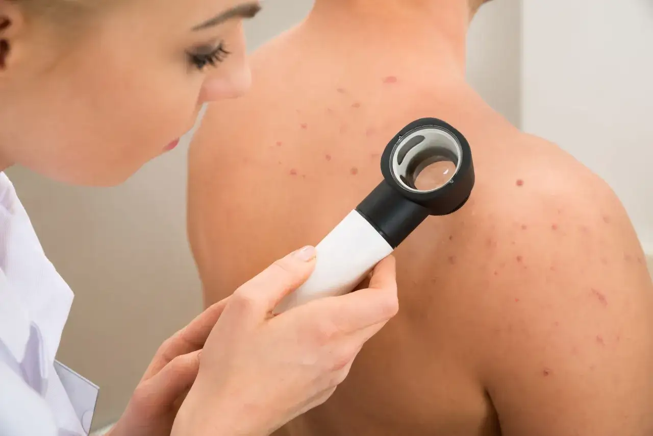 dermatoskopia badanie pieprzyk&oacute;w