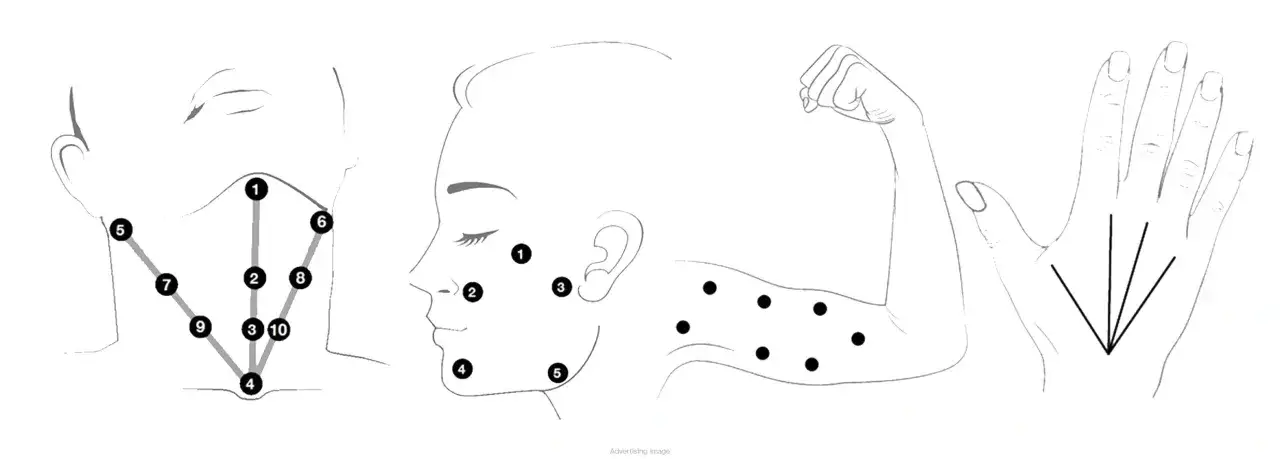 Schematiska illustrationer visar injektionspunkter för behandlingar som Profhilo. Hur ofta dessa behandlingar bör utföras beror på individens behov.