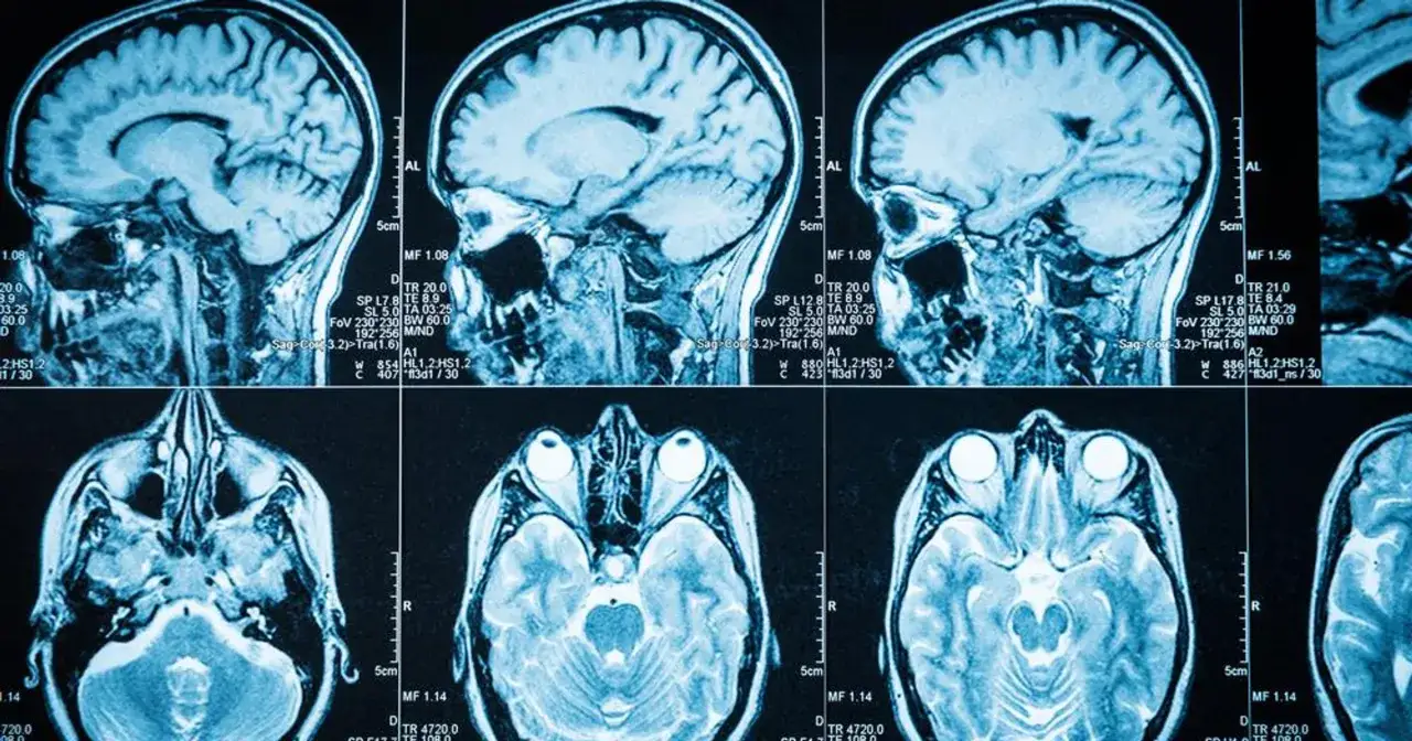 Przekroje mózgu na rezonansie magnetycznym, ukazujące jego strukturę. Obraz może być pomocny w diagnostyce, np. w wykrywaniu raka mózgu.