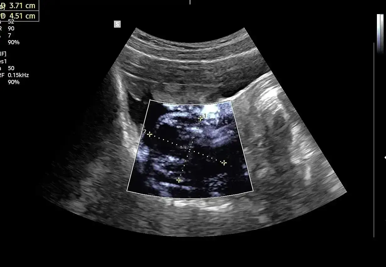 USG jamy brzusznej pokazuje torbiel na jajniku. Wymiary 3.71 cm i 4.51 cm. Objawy torbieli mogą być różne.
