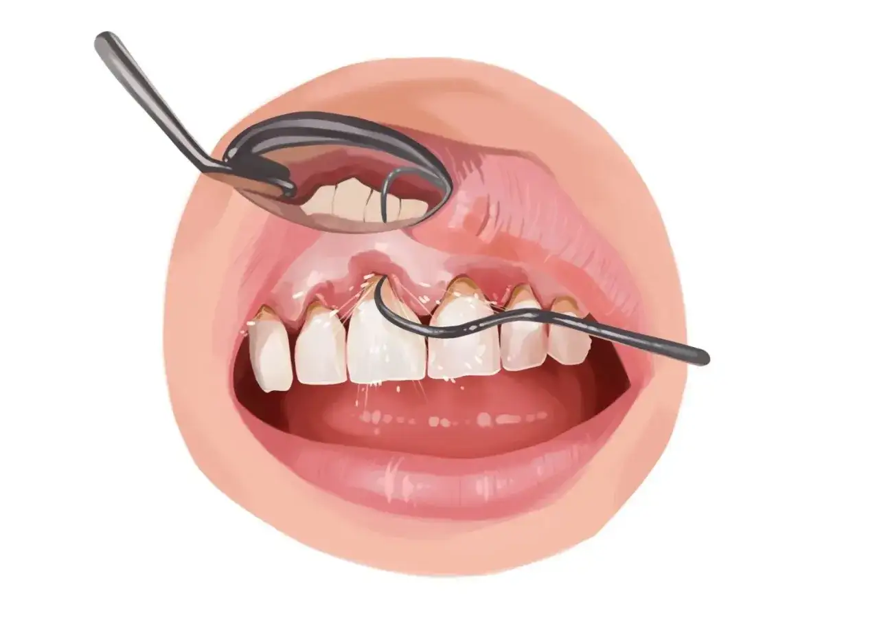 Denti con evidente tartaro sottogengivale, visibile grazie a uno specchietto dentale e uno strumento di pulizia.