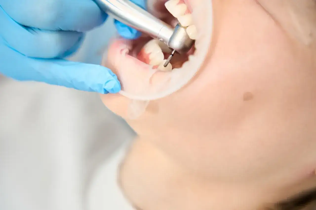 Dentysta w niebieskiej rękawiczce używa wiertła do opracowania zęba, który wygląda jak suchy zębodół.