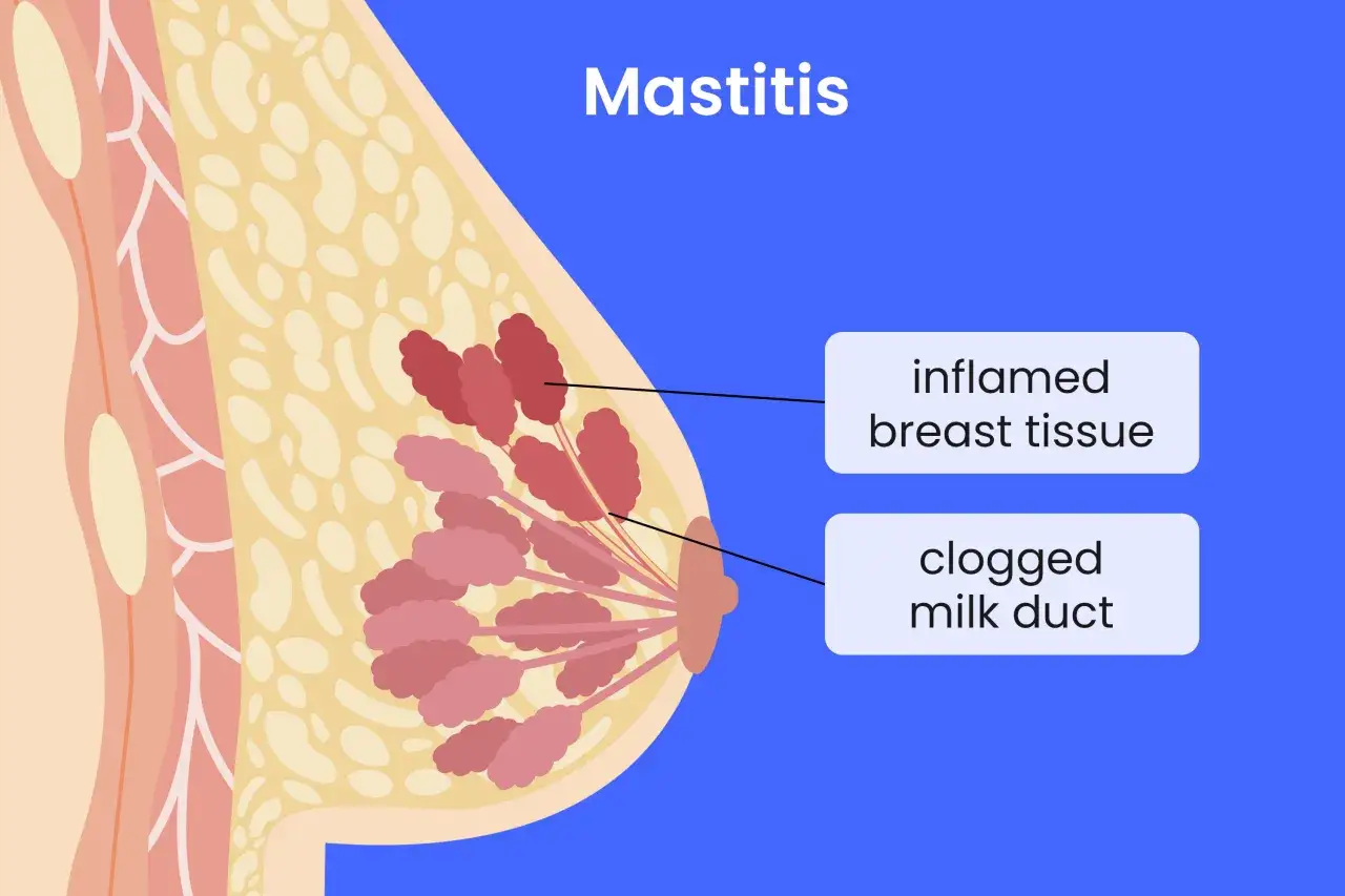 Illustration d'un sein montrant une mastite infectieuse avec tissu mammaire enflammé et un canal galactophore bouché.