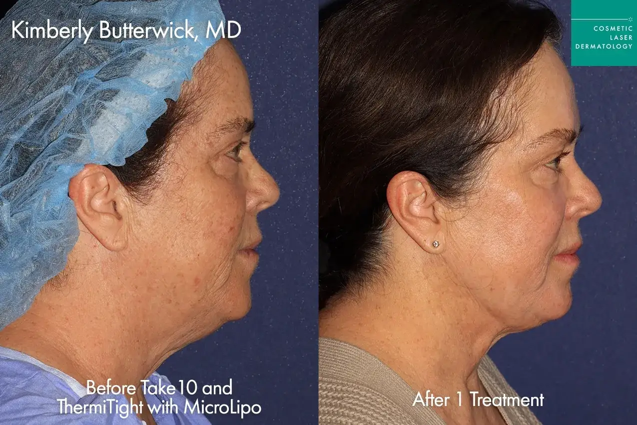 Antes y despu&eacute;s de un tratamiento para el cuello fl&aacute;cido. La imagen muestra una mejora notable en la firmeza del cuello.