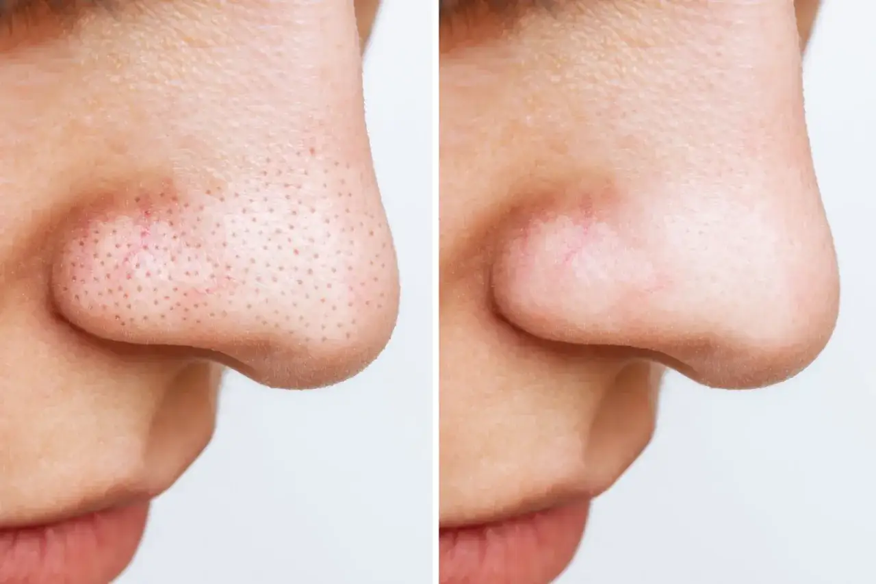 Avant/après : le nez avant et après l'extraction de gros points noirs. La peau est plus nette et lisse.