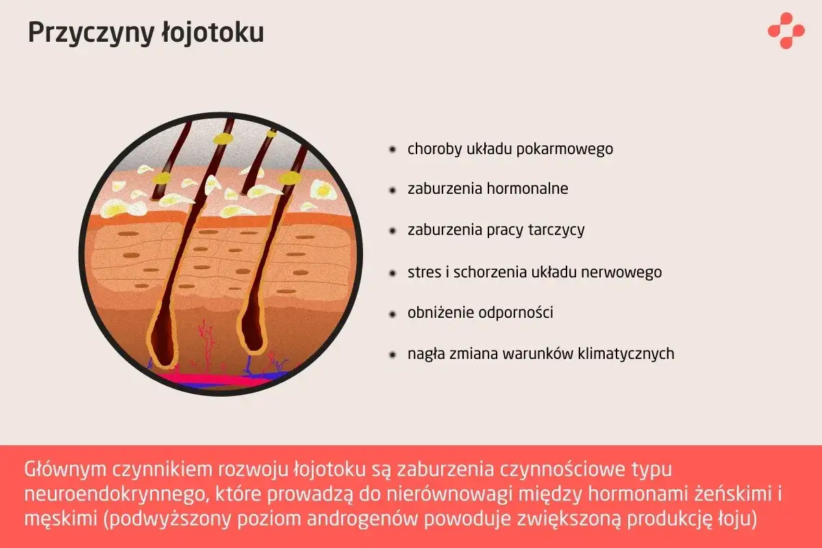przyczyny łojotoku infografika