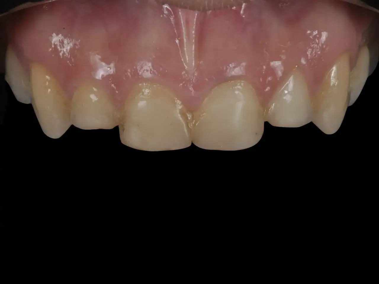 Primo piano di denti anteriori con gengive rosa. Alcuni denti presentano una superficie leggermente ruvida, con sfumature giallastre.