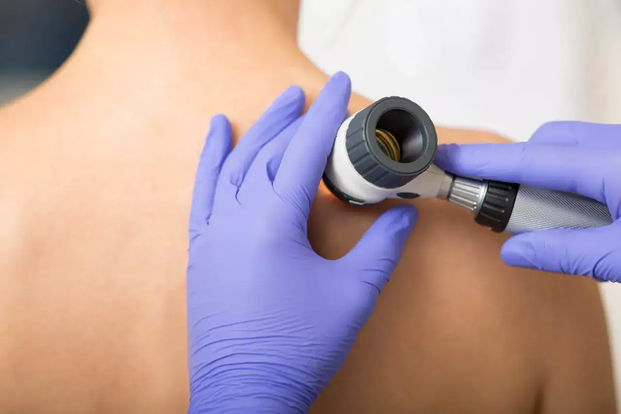 Dermatolog bada pieprzyk na plecach pacjenta za pomocą dermatoskopu.