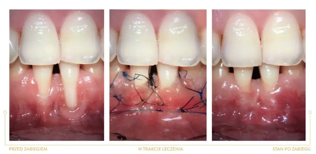 periodontolog leczenie dziąseł