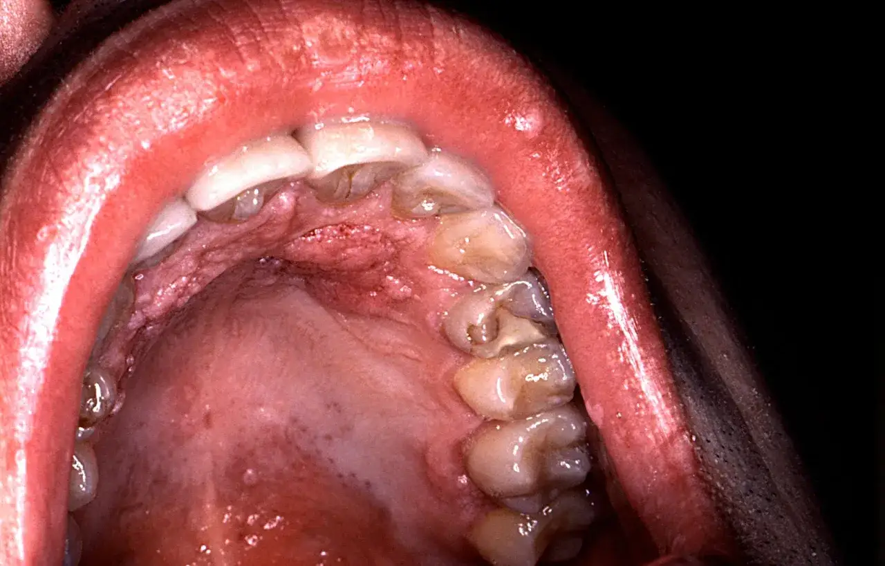 Zmiany na podniebieniu i dziąsłach, widoczne na zdjęciu, mogą być objawami wirusa HPV.
