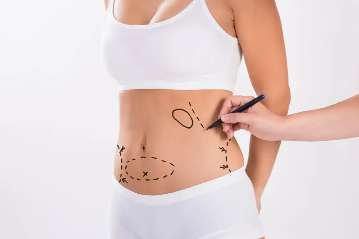 Kobieta z zaznaczonymi obszarami na brzuchu do zabiegu. Pytanie: liposukcja ultradźwiękowa ile zabiegów?