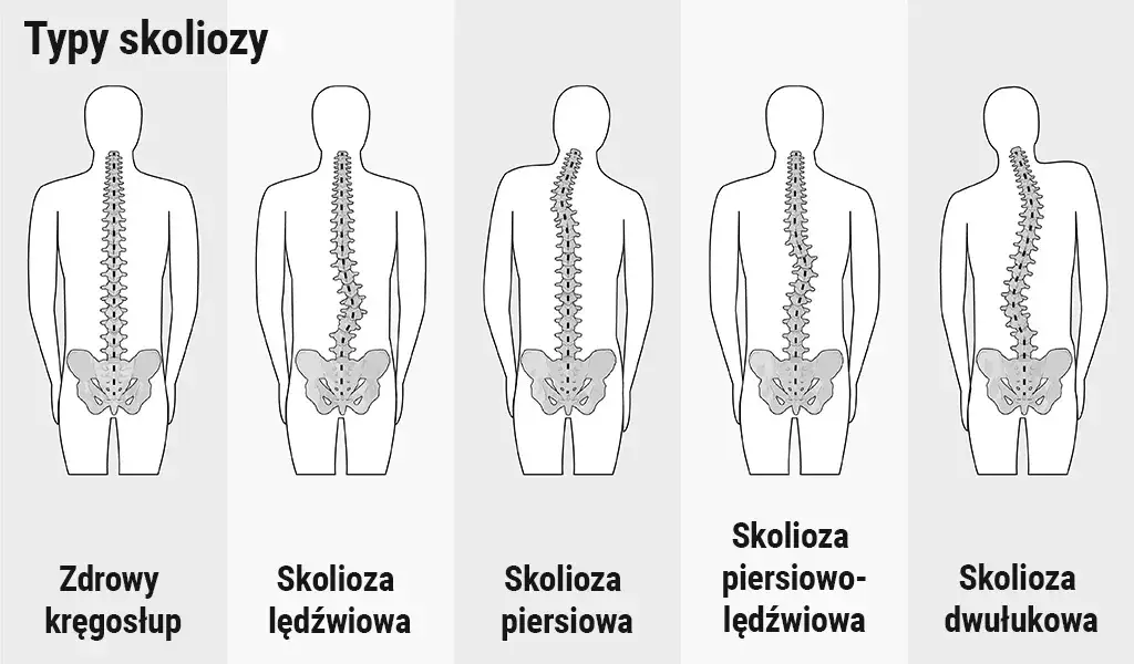 skolioza typy skrzywienia kręgosłupa