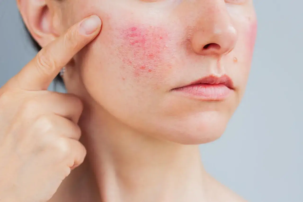 N&auml;ra bild p&aring; en kvinna som pekar p&aring; sin kind d&auml;r rodnad och utslag syns, vilket indikerar behovet att behandla rosacea.