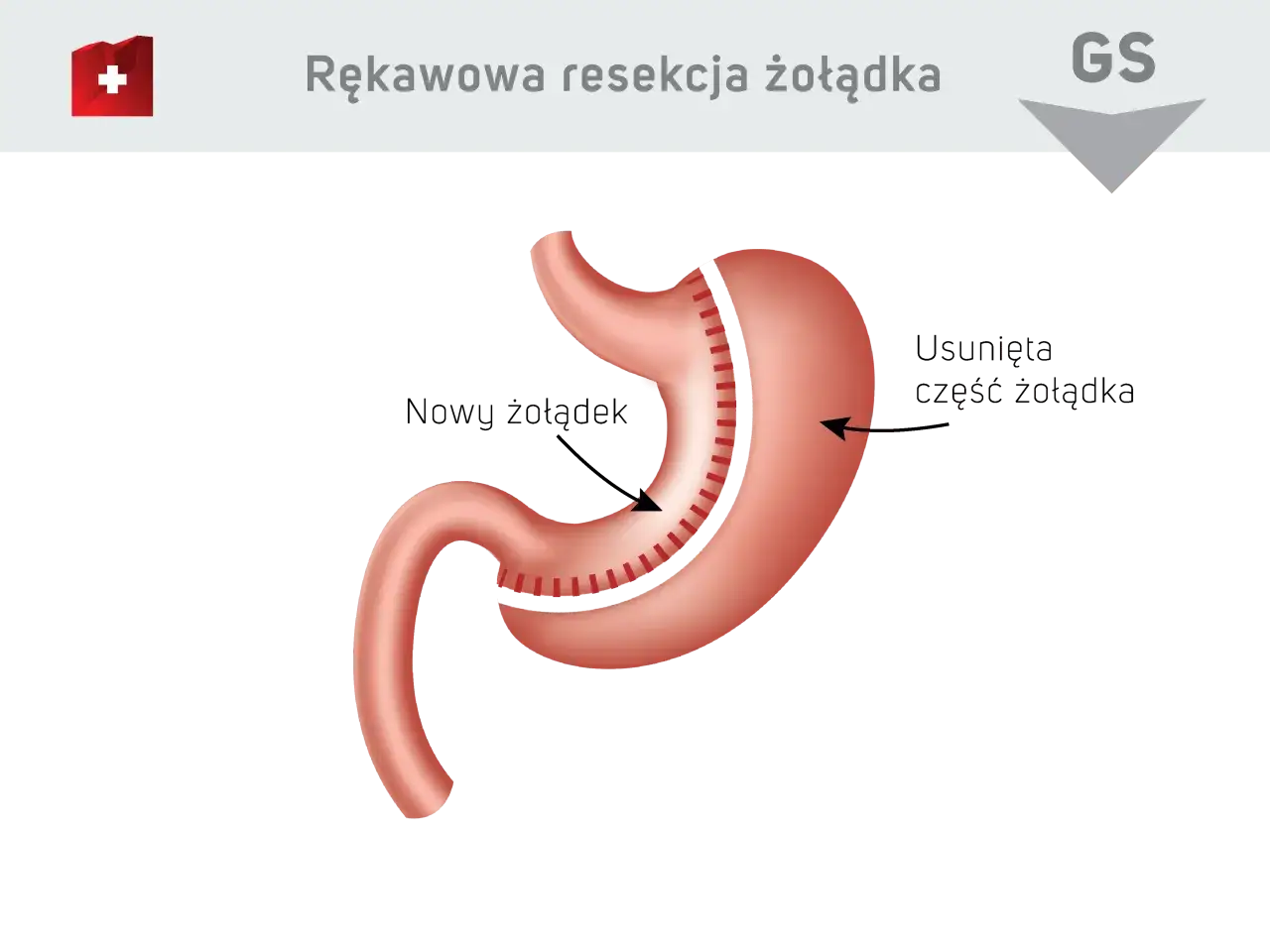 Ilustracja przedstawia żołądek po zabiegu rękawowej resekcji żołądka. Usunięto część żołądka, tworząc nowy, mniejszy żołądek.