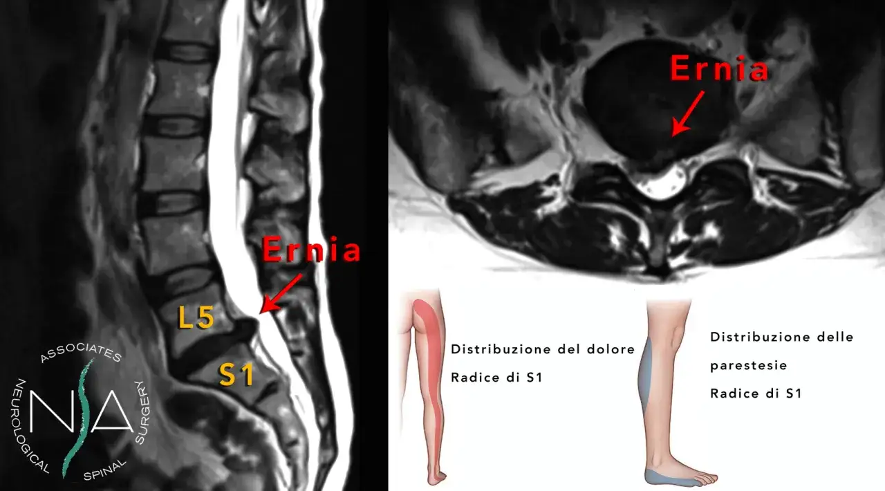 Risonanza magnetica mostra ernia discale L5-S1, causa di lombosciatalgia acuta che non passa, con dolore e parestesie alla radice di S1.