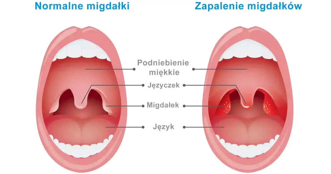 migdałki podniebienne