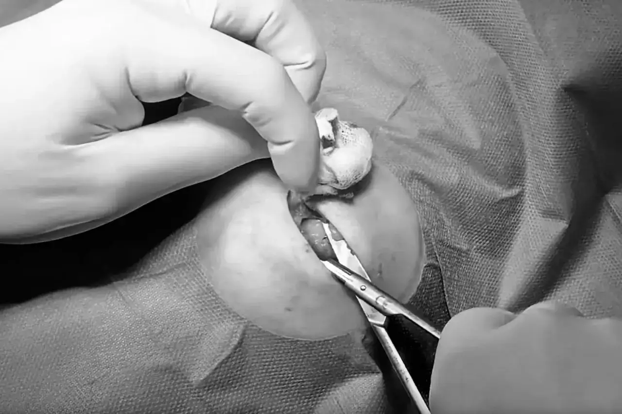 Chirurgische Entfernung eines Lipoms. H&auml;nde in Handschuhen halten Instrumente, um das Lipom zu entfernen.