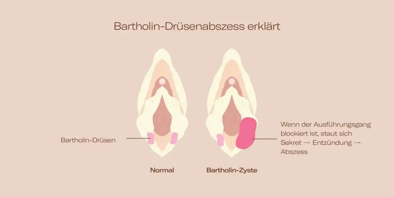 Vergleich von normaler Bartholin-Drüse und Bartholin-Zyste/Abszess im Intimbereich. Bei Blockade staut sich Sekret, was zu Entzündung und Abszess führt.