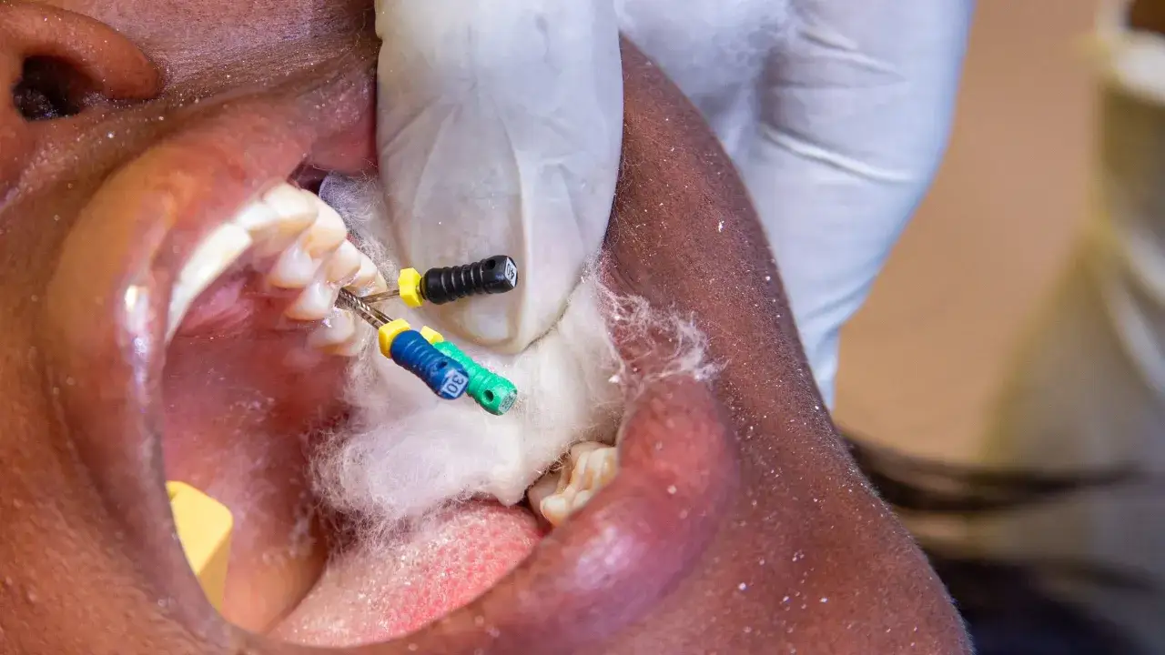 Detalles de la extracci&oacute;n de muela infectada. Instrumentos dentales en uso.
