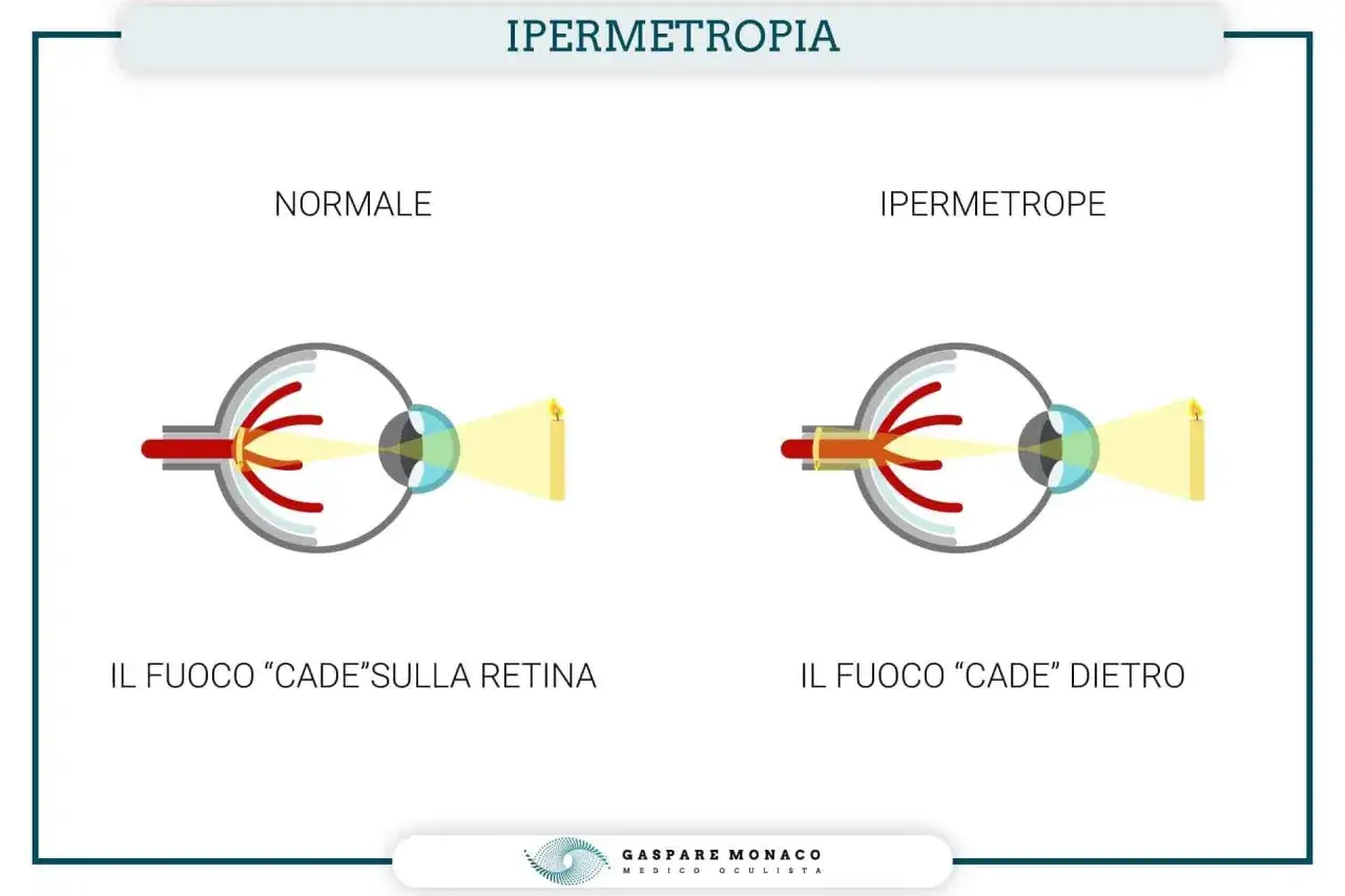 Confronto tra occhio normale e ipermetrope: nel secondo, il fuoco cade dietro la retina, mostrando come vede un ipermetrope.