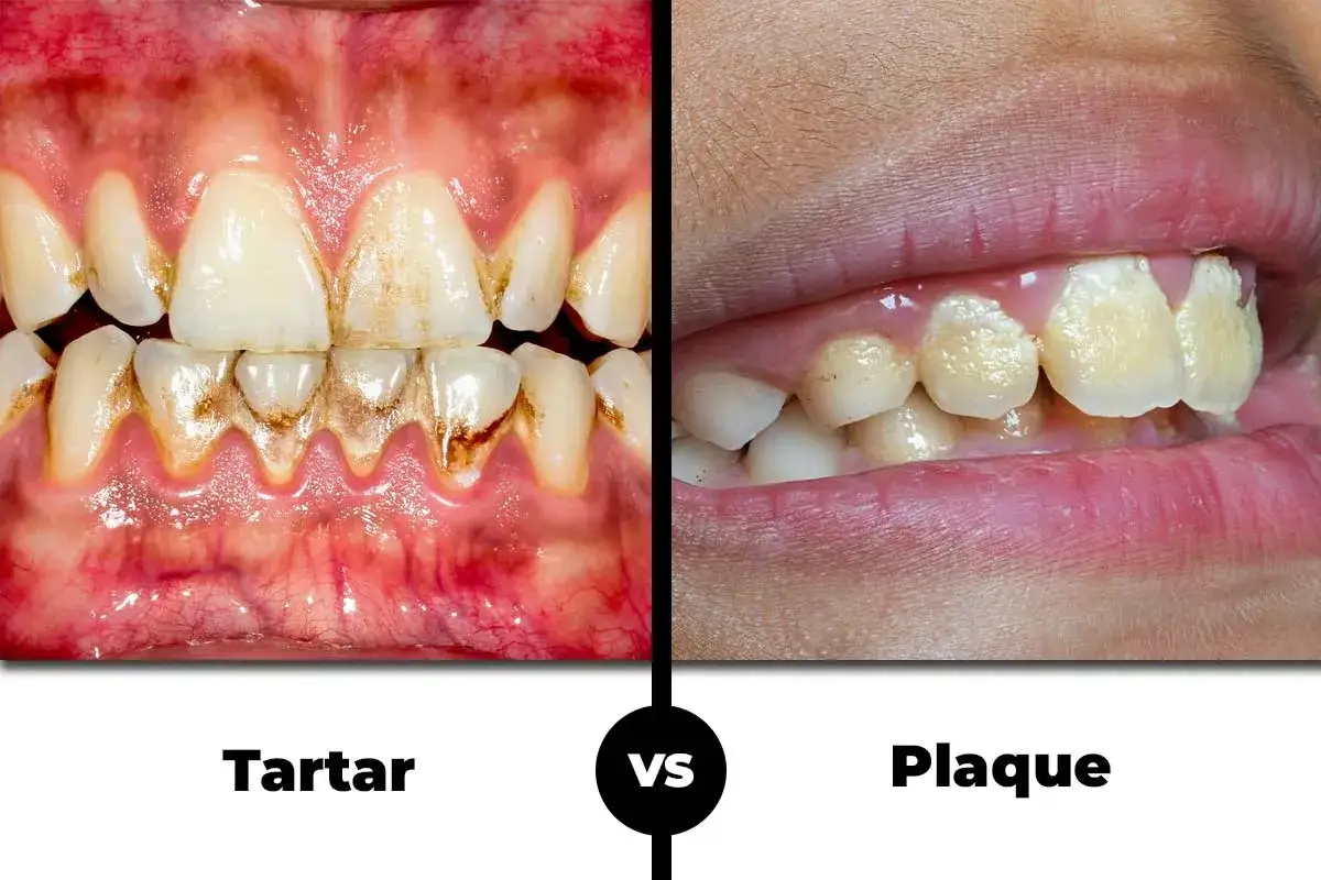 Confronto visivo: da un lato, denti con tartaro scuro e incrostato; dall'altro, denti con placca giallastra.