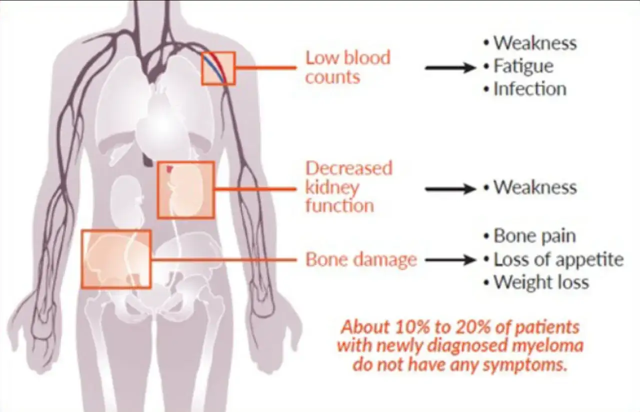 Illustration zeigt multiples Myelom: niedrige Blutwerte, Nierenfunktion, Knochenschäden. Woran stirbt man? Schwäche, Müdigkeit, Infektionen, Knochenschmerzen, Gewichtsverlust.