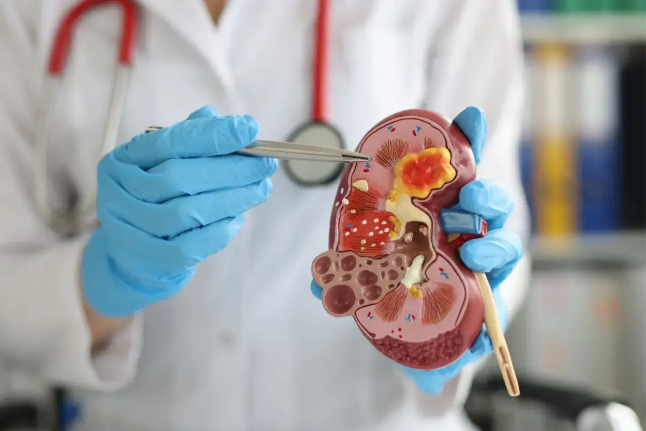 Lekarz w niebieskich rękawiczkach pokazuje model nerki, wskazując na obszar sugerujący ureterocele.