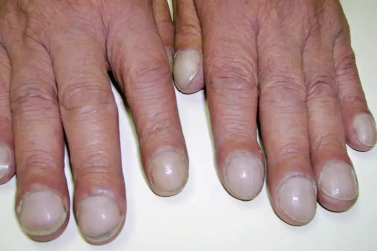H&auml;nde mit trommelschlegelfinger-&auml;hnlichen Verdickungen an den Fingerendgliedern und blassen N&auml;geln.