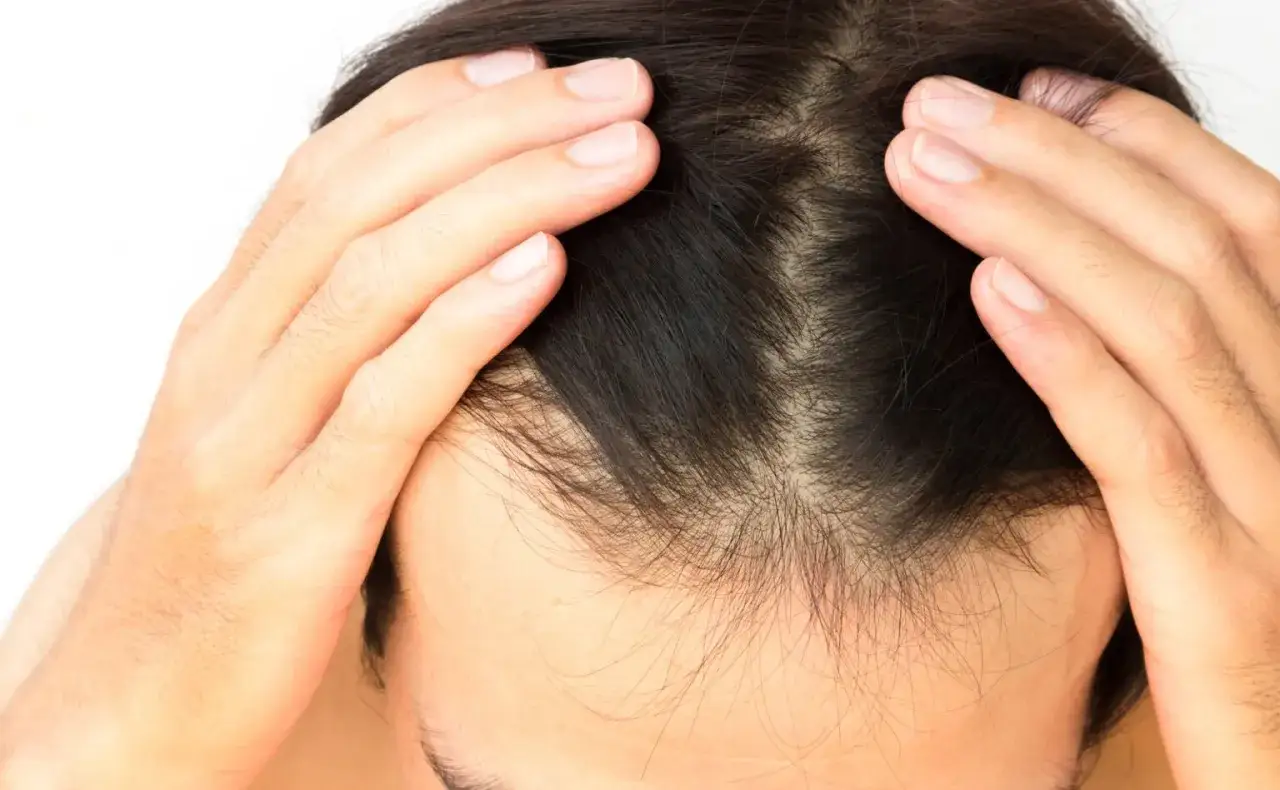 Mains sur le crâne, révélant une perte de cheveux visible, possiblement liée au covid.