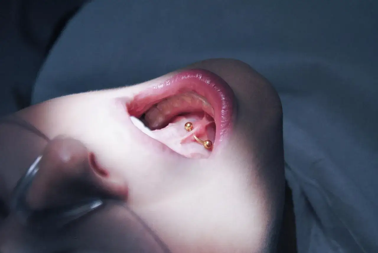 Uszkodzenia zębów od kolczyka w języku, recesja dziąseł od piercingu