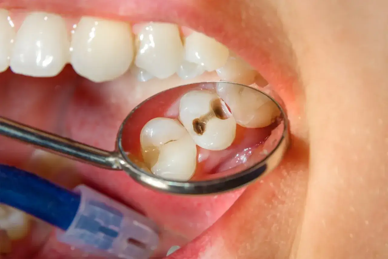 Zepsuty ząb z widoczną próchnicą w odbiciu lusterka dentystycznego.
