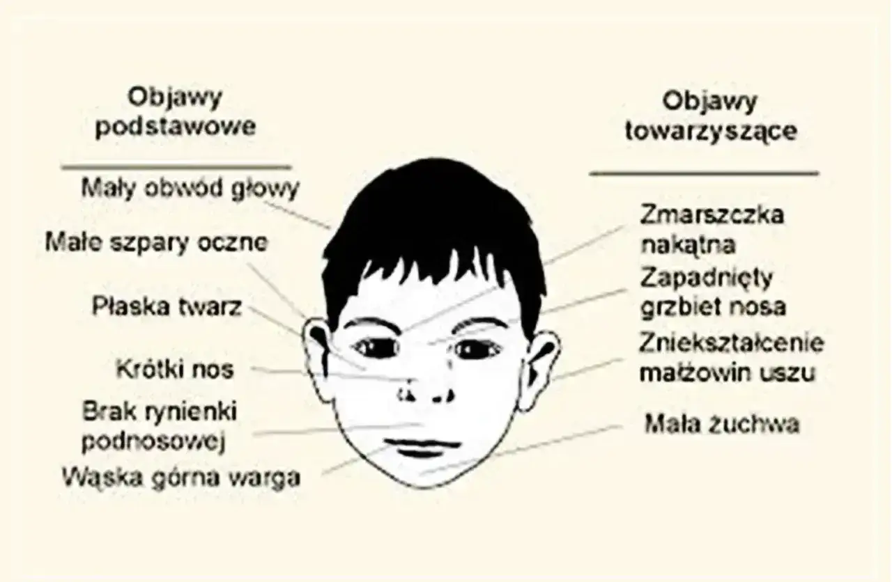 Ilustracja przedstawia rysunek twarzy dziecka z zaznaczonymi cechami, które mogą wskazywać na FAS (płodowy zespół alkoholowy).