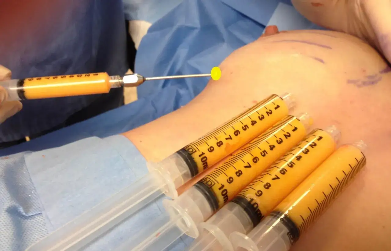Siringhe piene di grasso per lipofilling seno. Si valutano i rischi di questa procedura estetica.