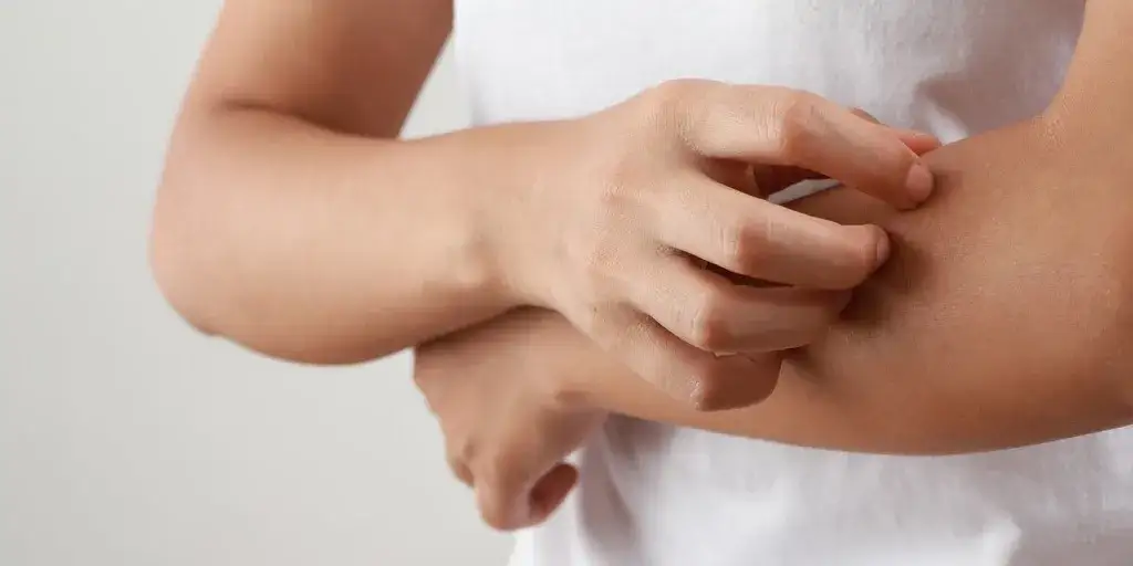 alergia na roztocza objawy sk&oacute;rne