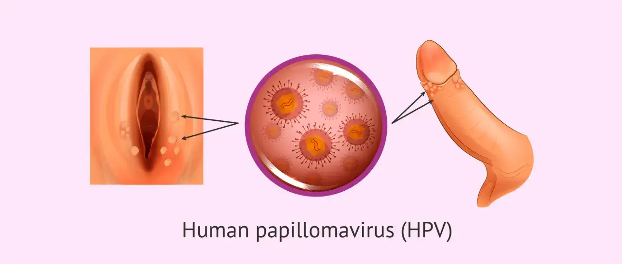 Ilustracja pokazuje kłykciny kończyste na narządach płciowych, spowodowane przez wirusa HPV.