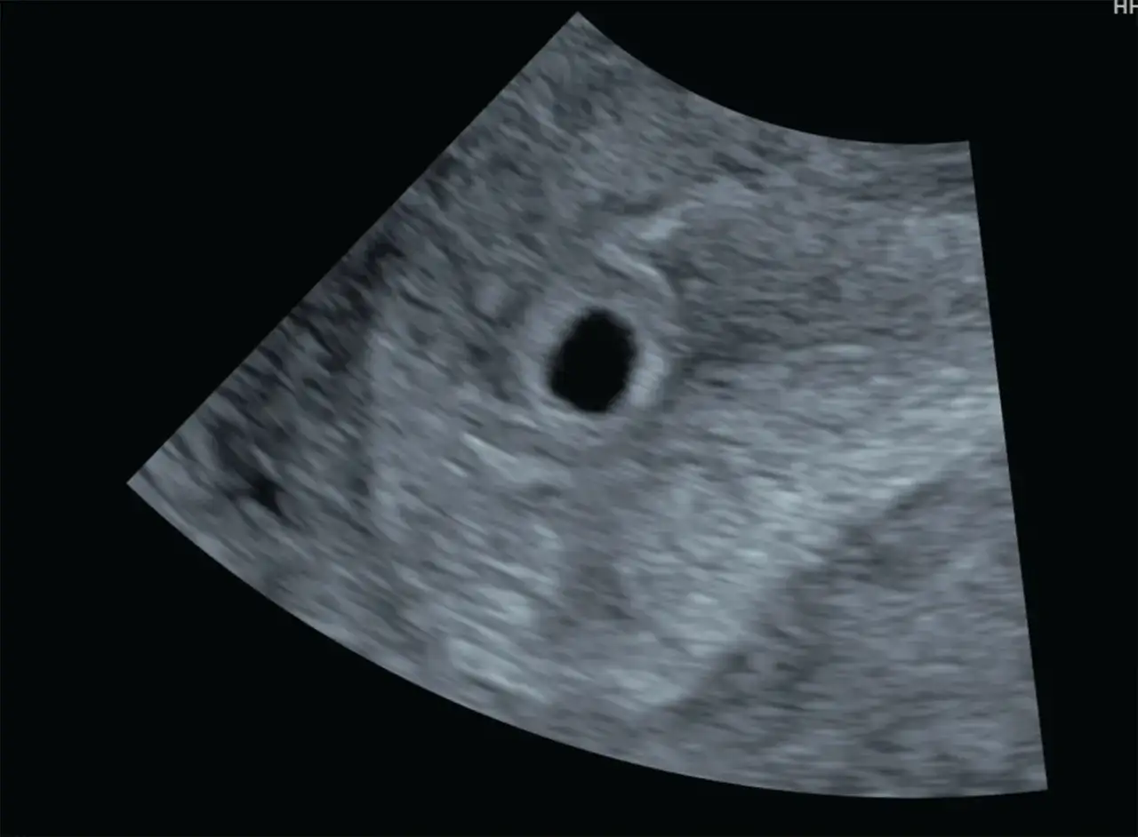 Ultraljudsbild visar en tom fostersäck, ett av flera tecken på missed abortion.