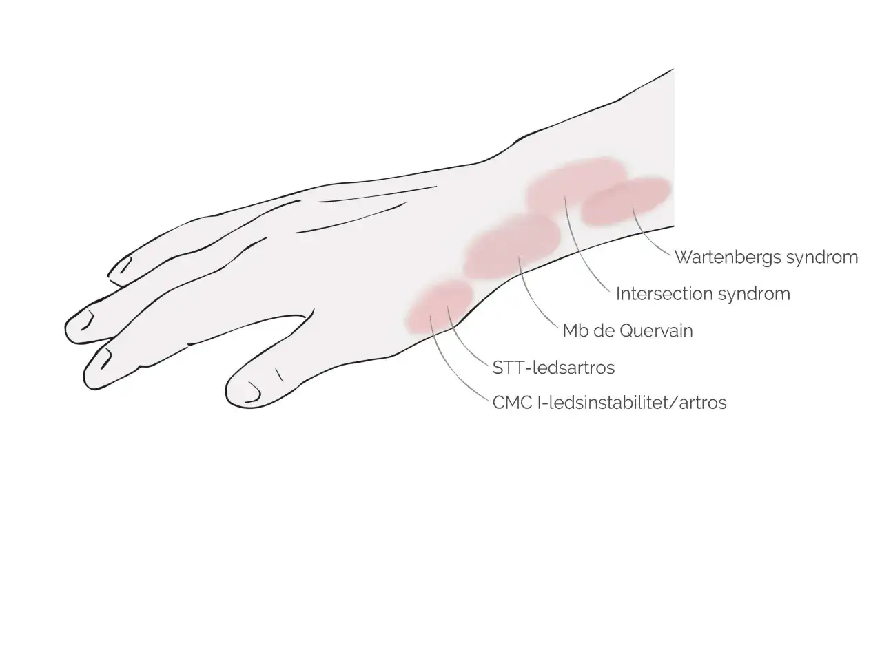Illustration av ont ovansida hand med markerade omr&aring;den f&ouml;r Wartenbergs syndrom, Intersection syndrom, Mb de Quervain, STT-ledsartros och CMC I-ledsinstabilitet/artros.