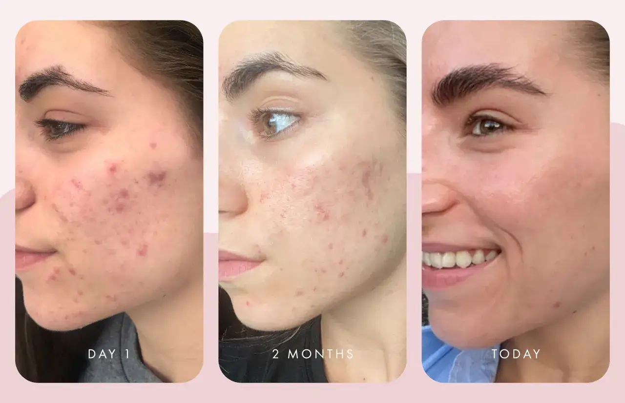 Avant/après : peau acnéique traitée avec acide salicylique et acide azélaïque. La peau est visiblement plus nette et apaisée.
