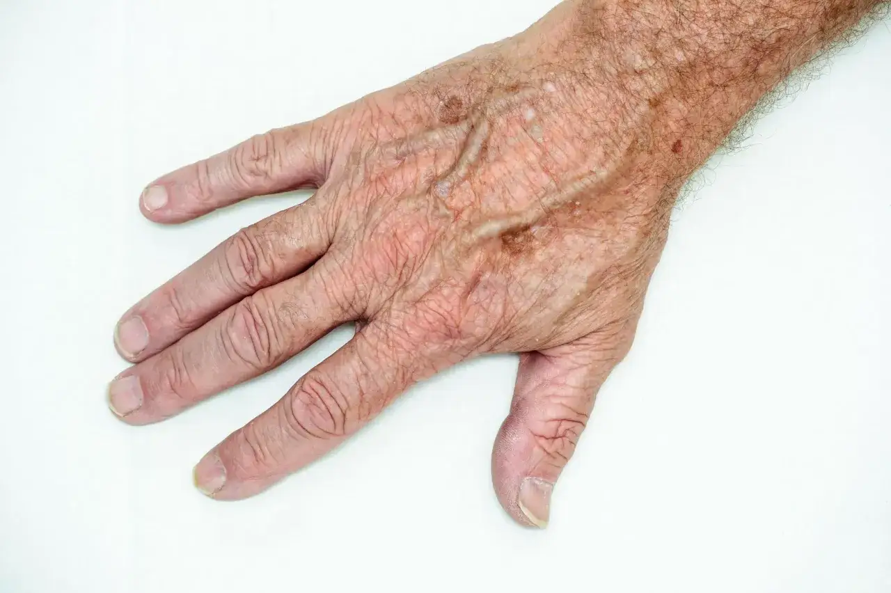 Mano anziana con pelle rugosa e macchie, indicative di malattie della pelle negli anziani.