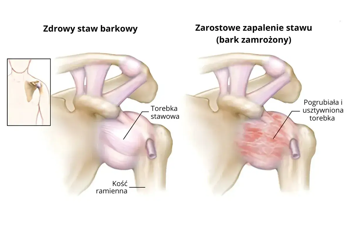 Porównanie zdrowego barku z zapaleniem barku objawy: pogrubiała i usztywniona torebka stawowa.