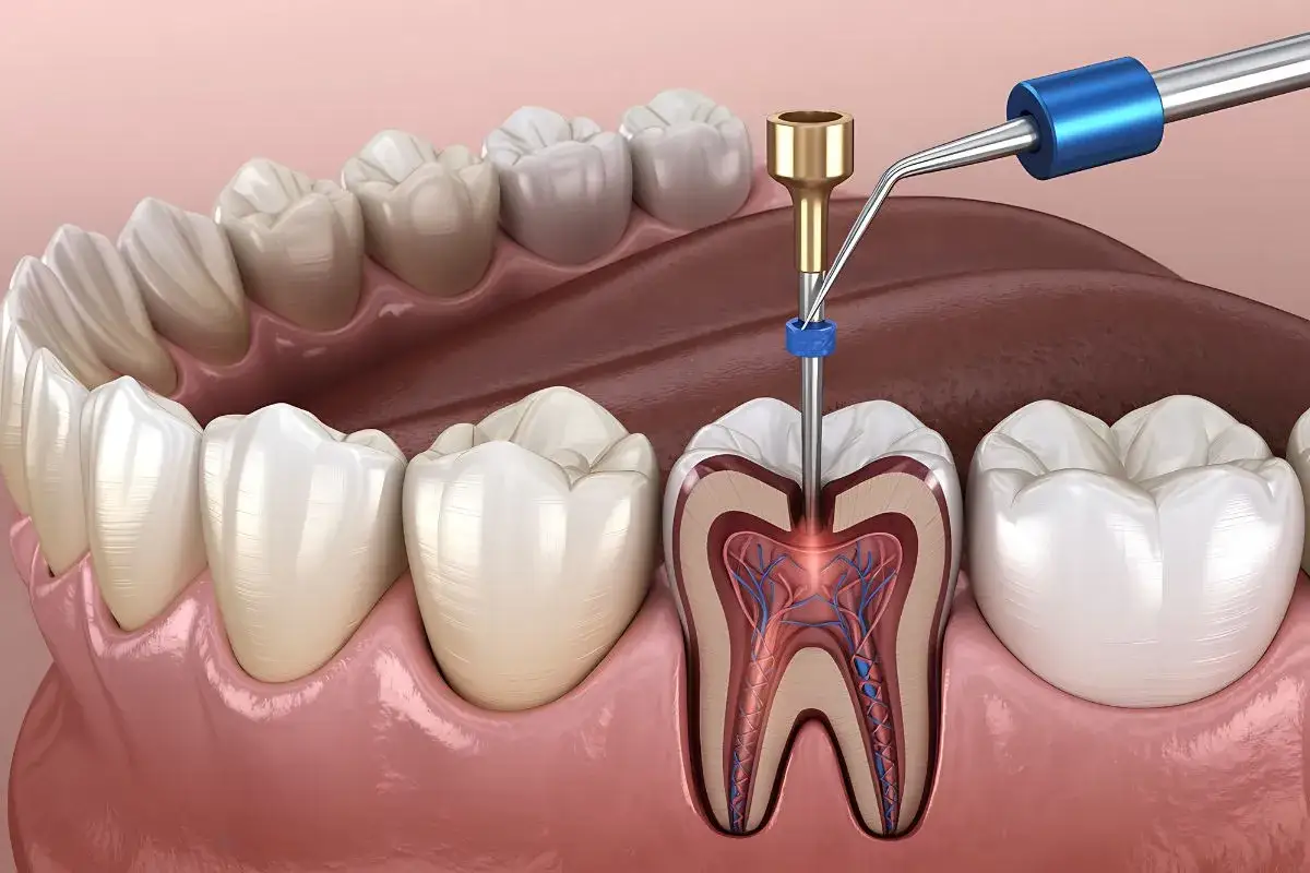 Procedimiento dental para tratar el dolor despu&eacute;s de una endodoncia, mostrando el interior de un diente.