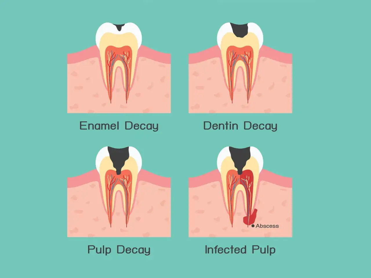 Illustrazione di quattro denti: carie smalto, carie dentina, carie polpa e polpa infetta con ascesso. La polpa dentale è il centro vitale del dente.
