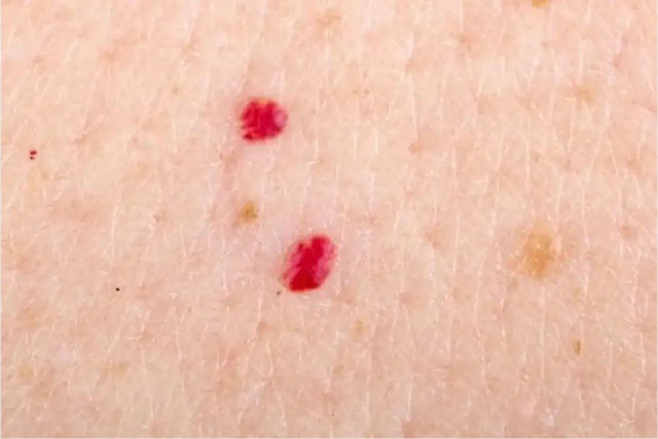 Gros plan sur une peau claire avec deux petits grains de beaut&eacute; rouges vifs et quelques taches pigmentaires.