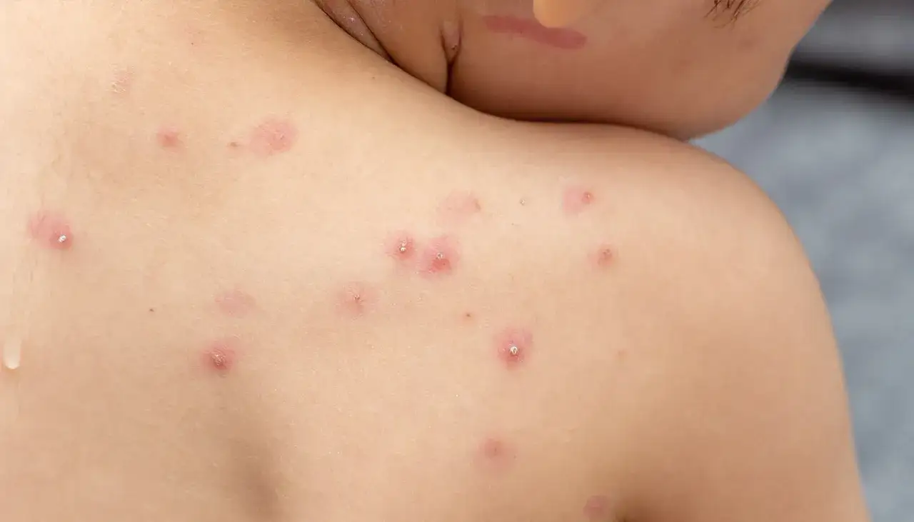 N&auml;rbild p&aring; ett barns hud med utslag som tyder p&aring; vattkoppor. R&ouml;da prickar och bl&aring;sor syns tydligt.