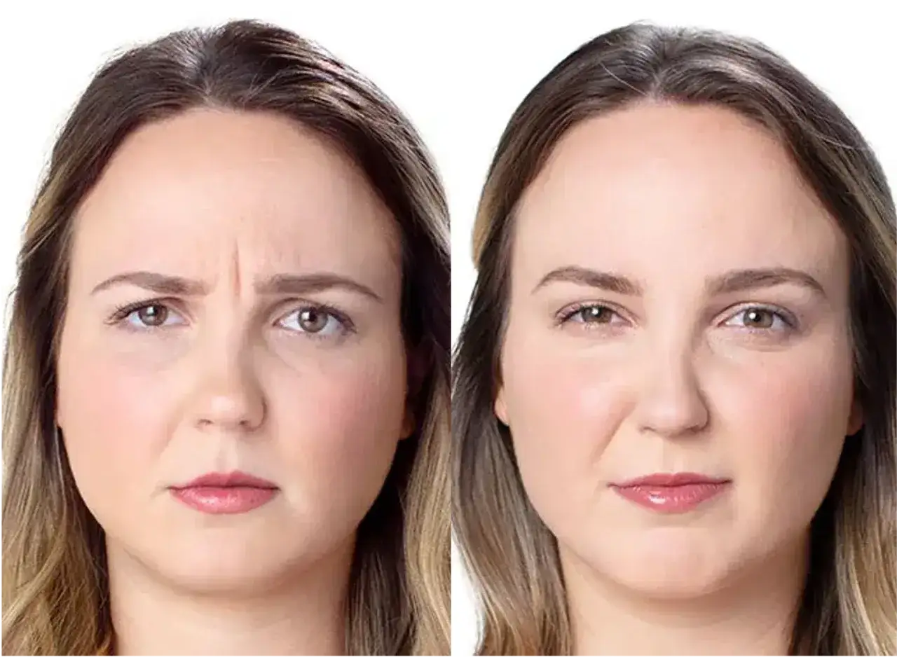 Avant/après : une femme souriante avec un front lisse, montrant comment atténuer le ride du lion.