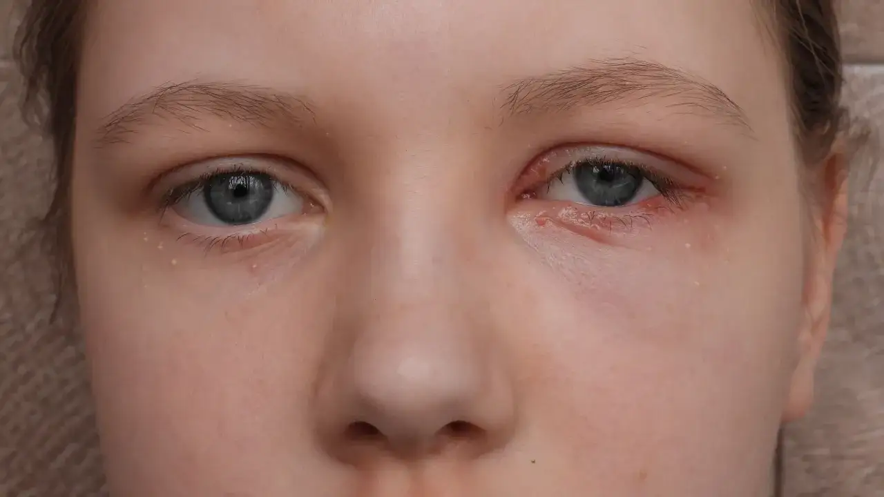 Widoczne pęcherzyki i zaczerwienienie na powiece, objawy opryszczki na oku.