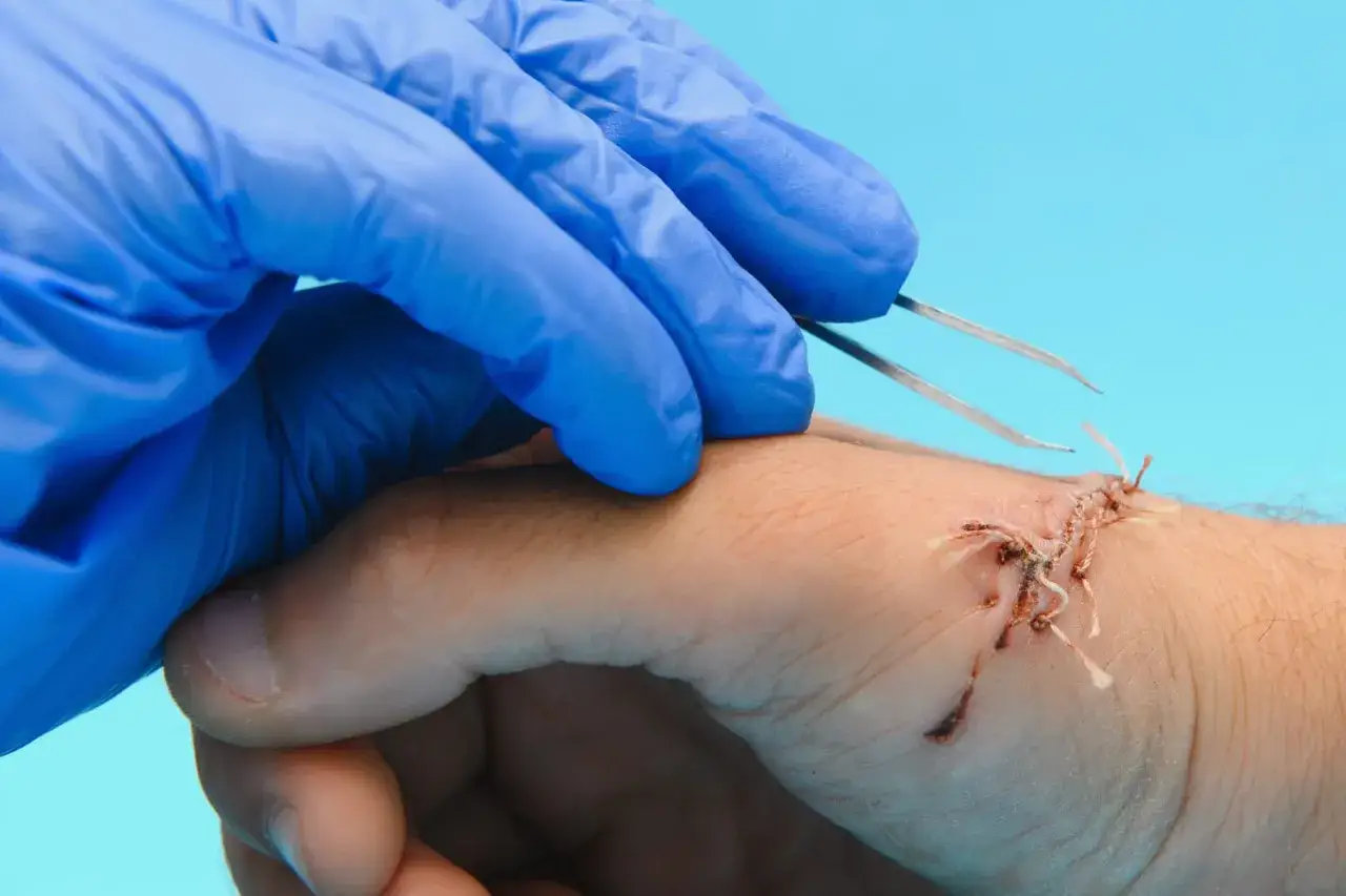Main d'un professionnel en gant bleu utilisant une pince pour enlever un point de suture sur une main blessée.